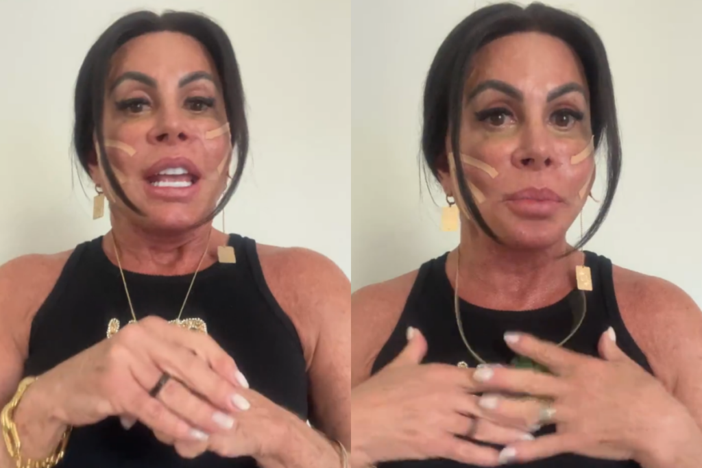 gretchen-aplica-fios-de-sustentacao-no-rosto;-medica-explica-tecnica