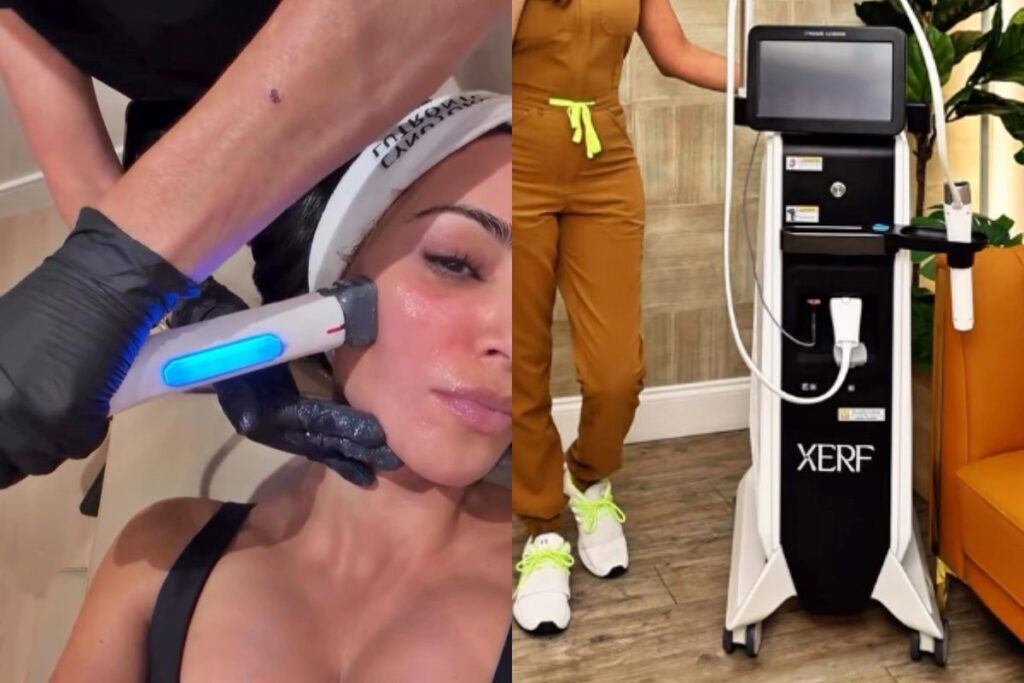 XERF: prós e contras do tratamento de beleza que estimula o colágeno xerf:-pros-e-contras-do-tratamento-de-beleza-que-estimula-o-colageno