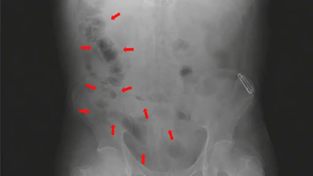 Pescaria termina em cirurgia de emergência após enguia viva de 65 centímetros entrar pelo reto e perfurar o intestino de homem em Bangladesh Pescaria termina em cirurgia de emergência após enguia viva de 65 centímetros entrar pelo reto e perfurar o intestino de homem em Bangladesh