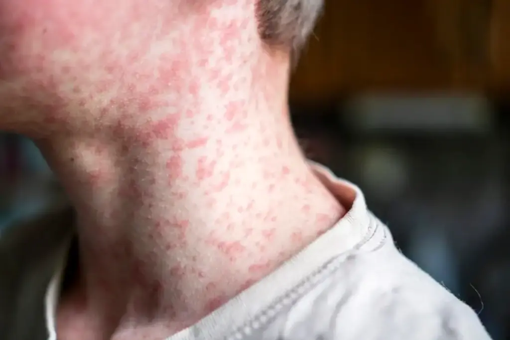 Com avanço do sarampo nas Américas e risco na fronteira, Acre ativa protocolo de alerta epidemiológico