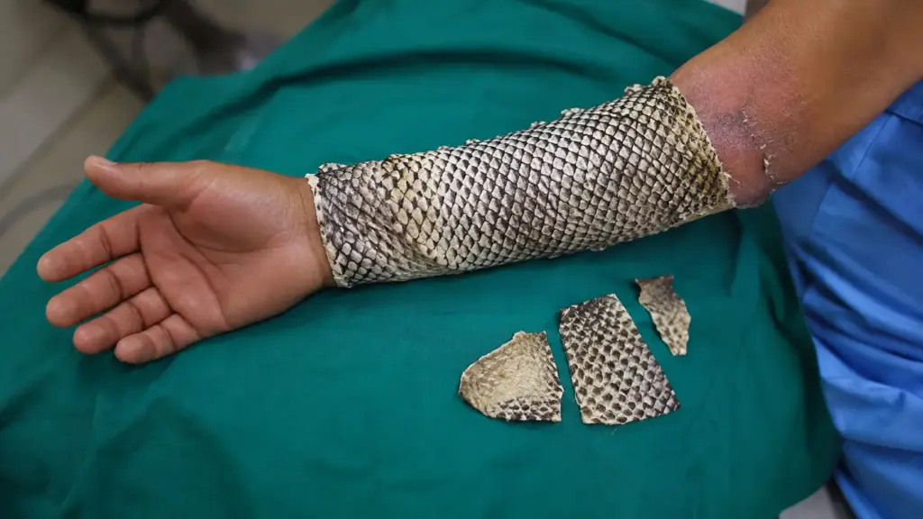 Pele de tilápia que iria para o lixo vira curativo para queimaduras e ganha fábrica de R$ 52 milhões no Ceará capaz de processar até 12 mil peles por dia Pele de tilápia que iria para o lixo vira curativo para queimaduras e ganha fábrica de R$ 52 milhões no Ceará capaz de processar até 12 mil peles por dia