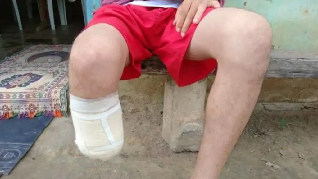 Homem de 26 anos contrata quatro seguros em poucas semanas, amputa o próprio pé e tenta receber até R$ 1,5 milhão alegando ter sido vítima de sequestro, mas Justiça identifica contradições na versão, mantém condenação por fraude e ele começa a cumprir pena em regime aberto